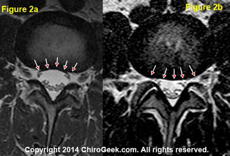 Disc Herniation Mri