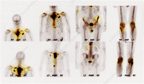 Bone scan showing multiple metastases - Stock Image - C027/1195 - Science Photo Library