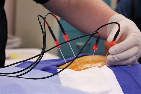 Radiofrequency Ablation - Healthy Kansas City