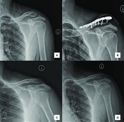 Distal Third Clavicle Fracture