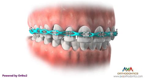 Orthodontic Power Chain Braces Before & After, Types, Use, Care, Pain ...