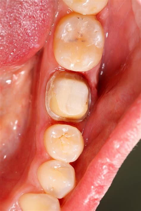 Gingival retraction: cord or cordless systems?