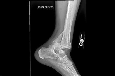 Ortho Dx: How would you treat this ankle fracture dislocation? - Clinical Advisor