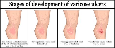 Skin Ulcer Stages