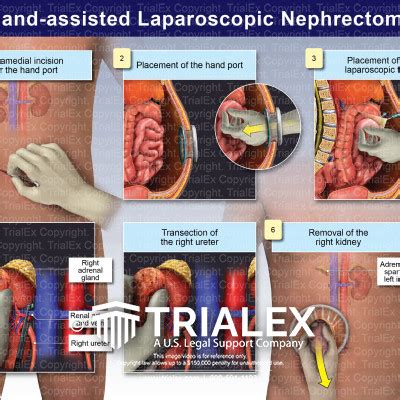 Hand-assisted Laparoscopic Nephrectomy - TrialExhibits Inc.