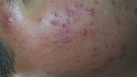 Where are acne nodules – Health News