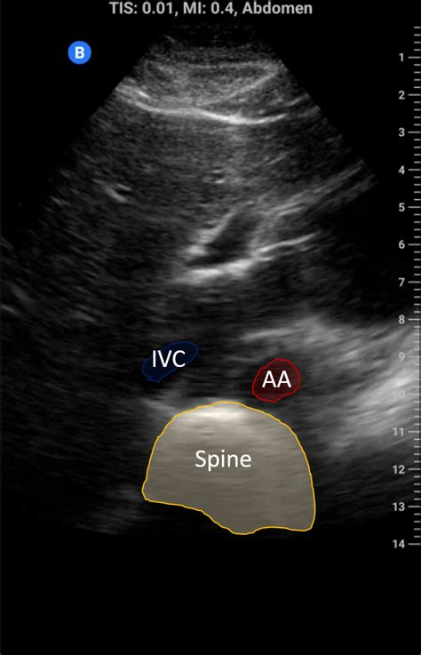 IVC Ultrasound – Toronto Internal Medicine POCUS