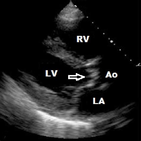 Aortic Stenosis — Kwak Talk