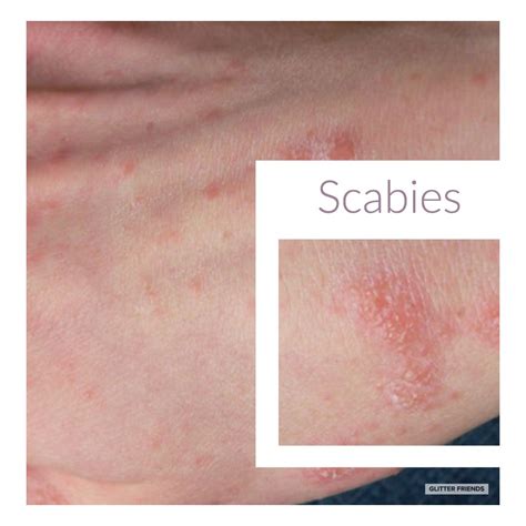 Scabies Mites On Humans