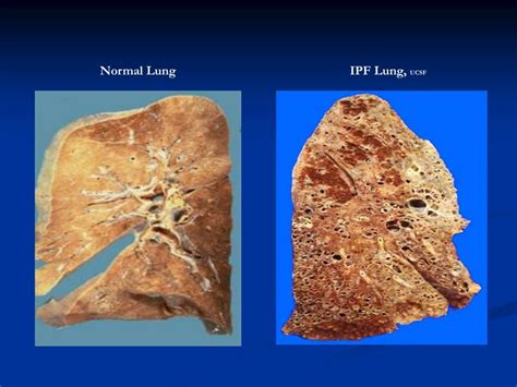 PPT - Pulmonary Fibrosis: Diagnosis 101 PowerPoint Presentation, free download - ID:232314