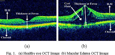 Clinically Significant Macular Edema Oct