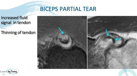 MRI Biceps Tendon ( Long Head) - Radedasia