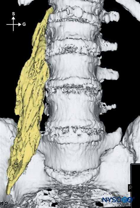 Lumbar Plexus Block