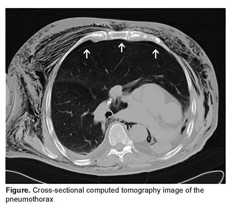 Pneumothorax in a Single Lung Patient - The Western Journal of Emergency Medicine