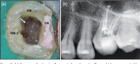 Figure 2 from Endodontic management of a C-shaped maxillary first molar with three independent ...