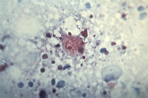 Rocky Mountain Spotted Fever Pictures : Rickettsia (Hardin MD / CDC)