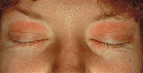 Eyelid Dermatitis (xeroderma of the eyelids, eczema of the eyelids ...