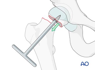 Total hip arthroplasty for Displaced subcapital femoral neck fractures