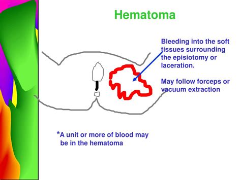 PPT - Complications Of Postpartum PowerPoint Presentation - ID:343782