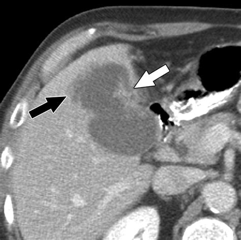 CT Differentiation of Adenomyomatosis and Gallbladder Cancer | AJR