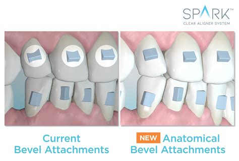 Orthodontic News - Spark Aligners Does It Again with Market Leading ...