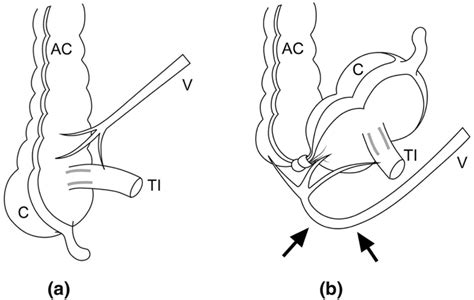 Drawings showing normal anatomy and anatomy with cecal volvulus.... | Download Scientific Diagram