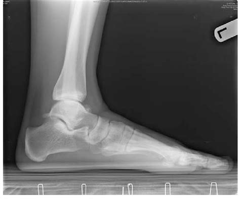 Lateral ankle X-ray showing large talar osteophyte in patient with... | Download Scientific Diagram