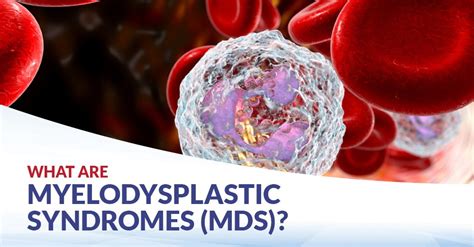 Myelodysplastic Syndromes | CFCH | Centre for Clinical Haematology