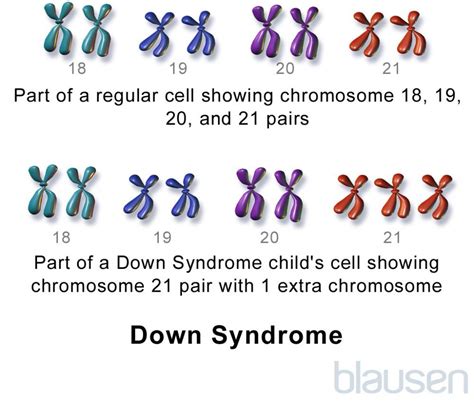 Down Syndrome (Trisomy 21) - Children's Health Issues - MSD Manual Consumer Version