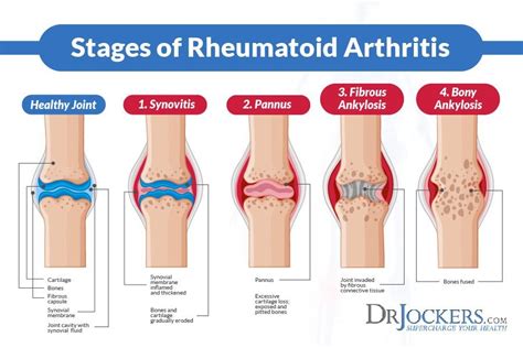 Arthritis: 7 most painful types of arthritis- cause, symptoms, treatments