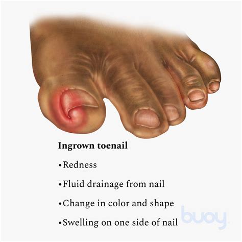 Ingrown Toenail Treatment Pain Relief Scholl's, 42% OFF