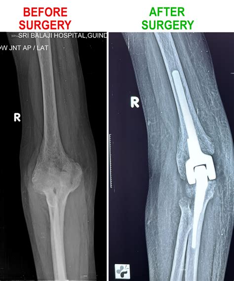 Elbow Replacement Surgery At Sri Balaji Hospital, Chennai