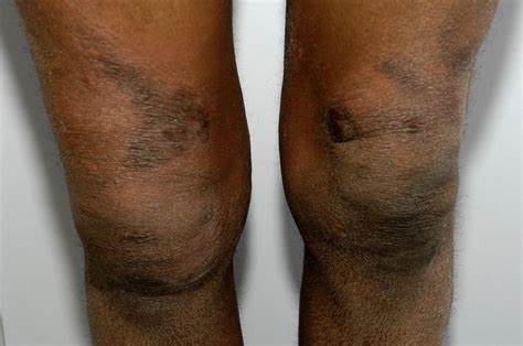 Eczema on black skin: Pictures, symptoms, and treatment