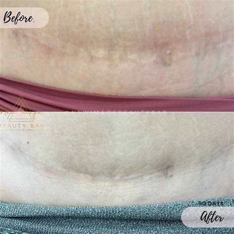 Tummy Tuck Scar Camouflage - Most Popular Treatments