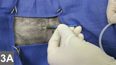 Central Venous Catheter Placement: Modified Seldinger Technique ...