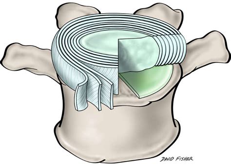 Section 1, Chapter 1: Anatomy of the Lumbar Intervertebral Discs ...