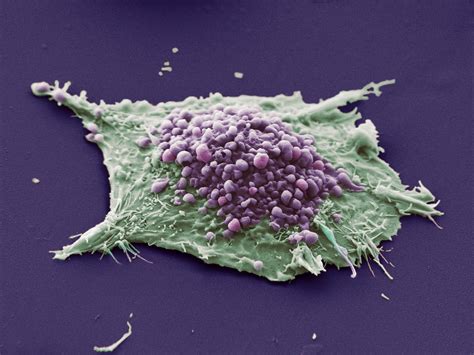 Lung cancer cell. This image shows a single cell grown from a culture of lung epithelial ...