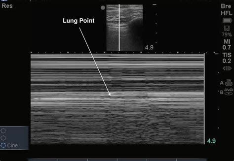 Pneumothorax Ultrasound / Lung Point Sign In Ultrasound Diagnostics Of ...