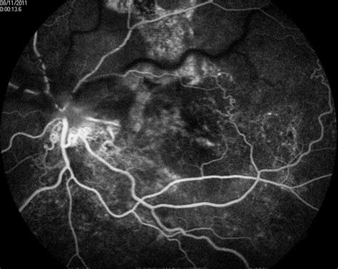 Racemose Hemangioma and Retinal Vein Occlusion - Retina Image Bank