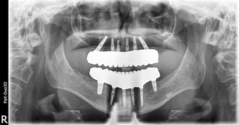 All On Dental Implants With Prettau Solid Zirconia Dental Implant Bridges ~A Case Explained ...