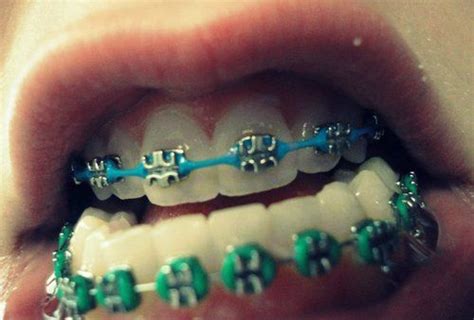 green braces | Green braces, Cute braces, Braces colors