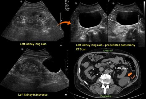 Ultrasound features of Kidney Cysts - Renal Fellow Network