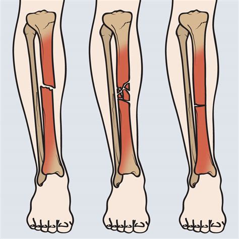 Types of tibia fracture – Welcome to SYS MEDTECH INTERNATIONAL PRIVATE ...