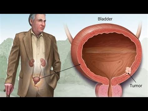 turbt surgery for urinary bladder tumor - YouTube