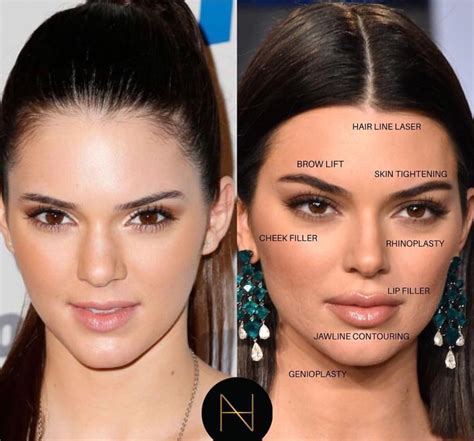 Pinterest | Facial fillers, Celebrity plastic surgery, Kendall jenner plastic surgery