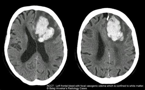 Hypertensive intracerebral bleed