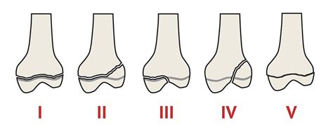 Salter-Harris Classification | Ortho X-Ray - MedSchool