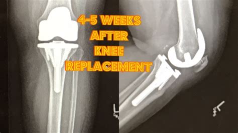 Total Knee Replacement Surgery 4-5 Week Post Op Recovery Log Update - YouTube