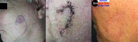 Skin cancer surgery - "marsden skin cancer clinic"