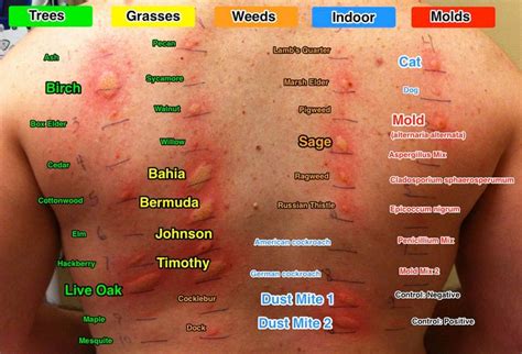 How to Control Your Dust Mite Allergy and Not to Let it Control You | Allergy remedies, Dust ...